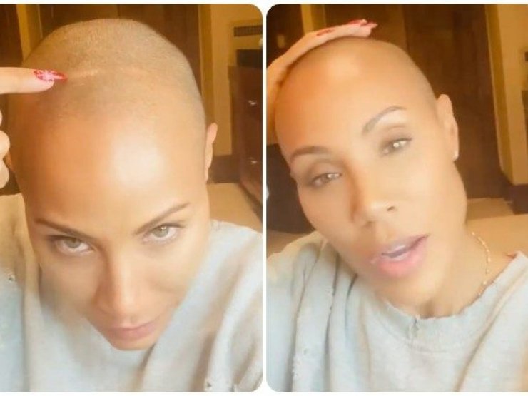 jada pinkette alopecia