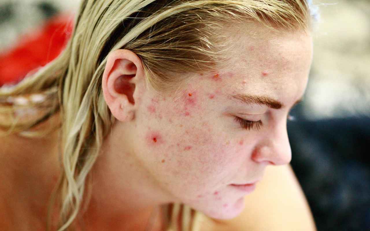 come curare l'acne causata dallo stress