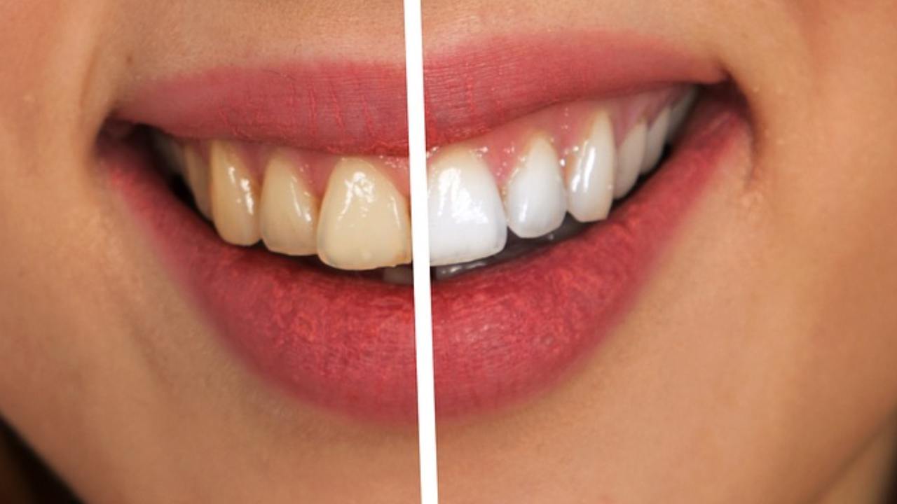 tattica per sbiancare i denti in modo naturale benefici